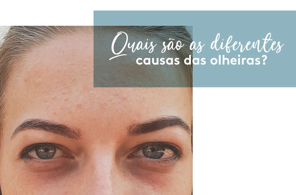 Quais são as diferentes causas das olheiras?